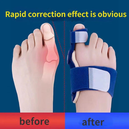 1 Pair of High - Quality Bunion Toe Corrector and Straightener - Tru Tulip